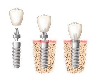 bursa implant dental implant