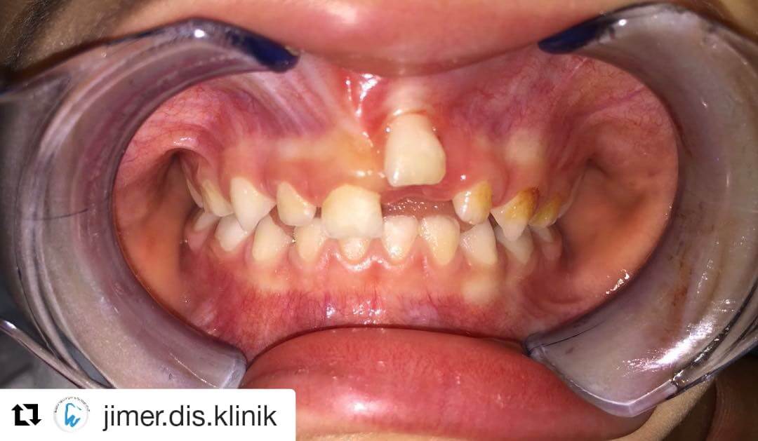 Çocuklarda Diş Yaralanmaları